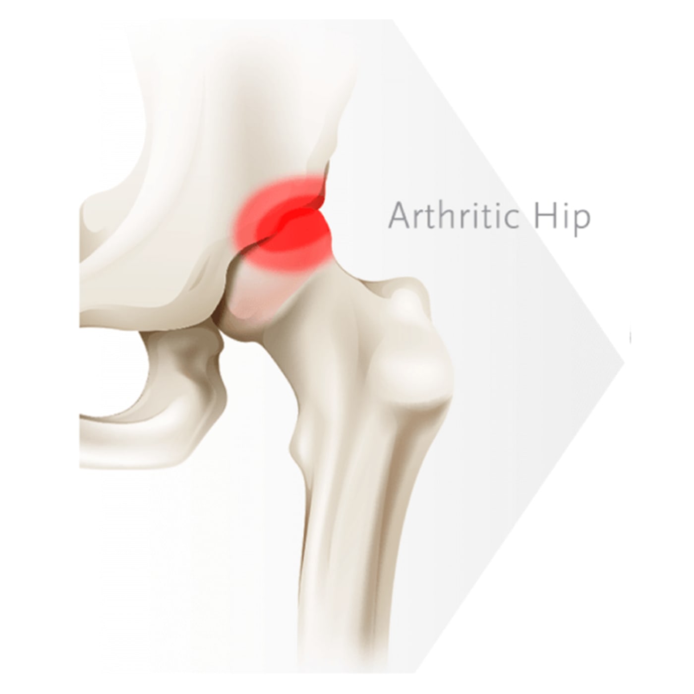 Knee Pain & Osteoarthritis Causes, Symptoms, Treatment