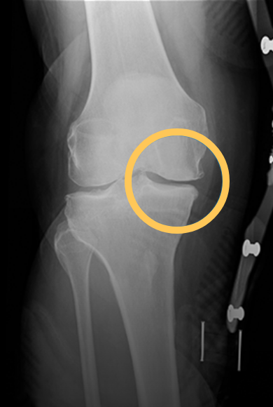 Unloader One X Knee Brace for Osteoarthritis